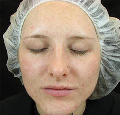 Na acne behandeling